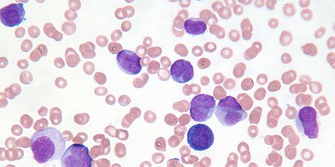 Common leukemia symptoms