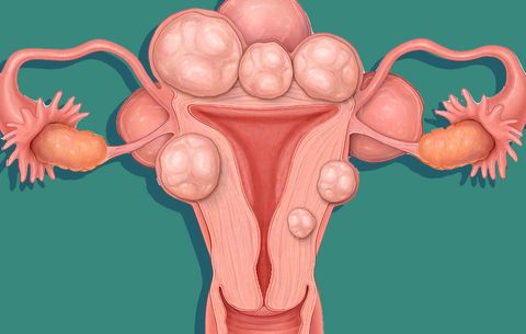 Women Are Now Posting Photos Of Their Uterine Fibroids All Over Reddit |  Women's Health