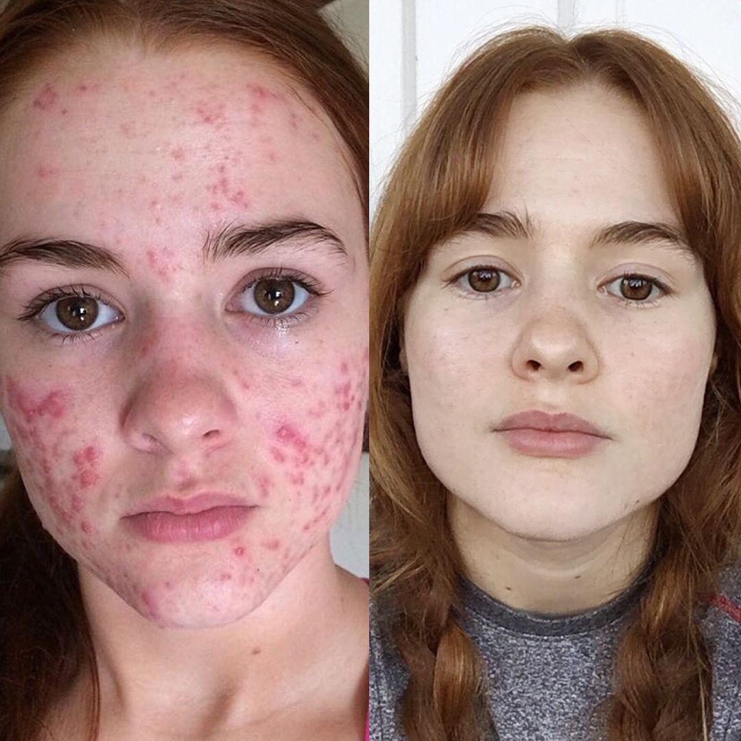 Accutane doesnt work options when