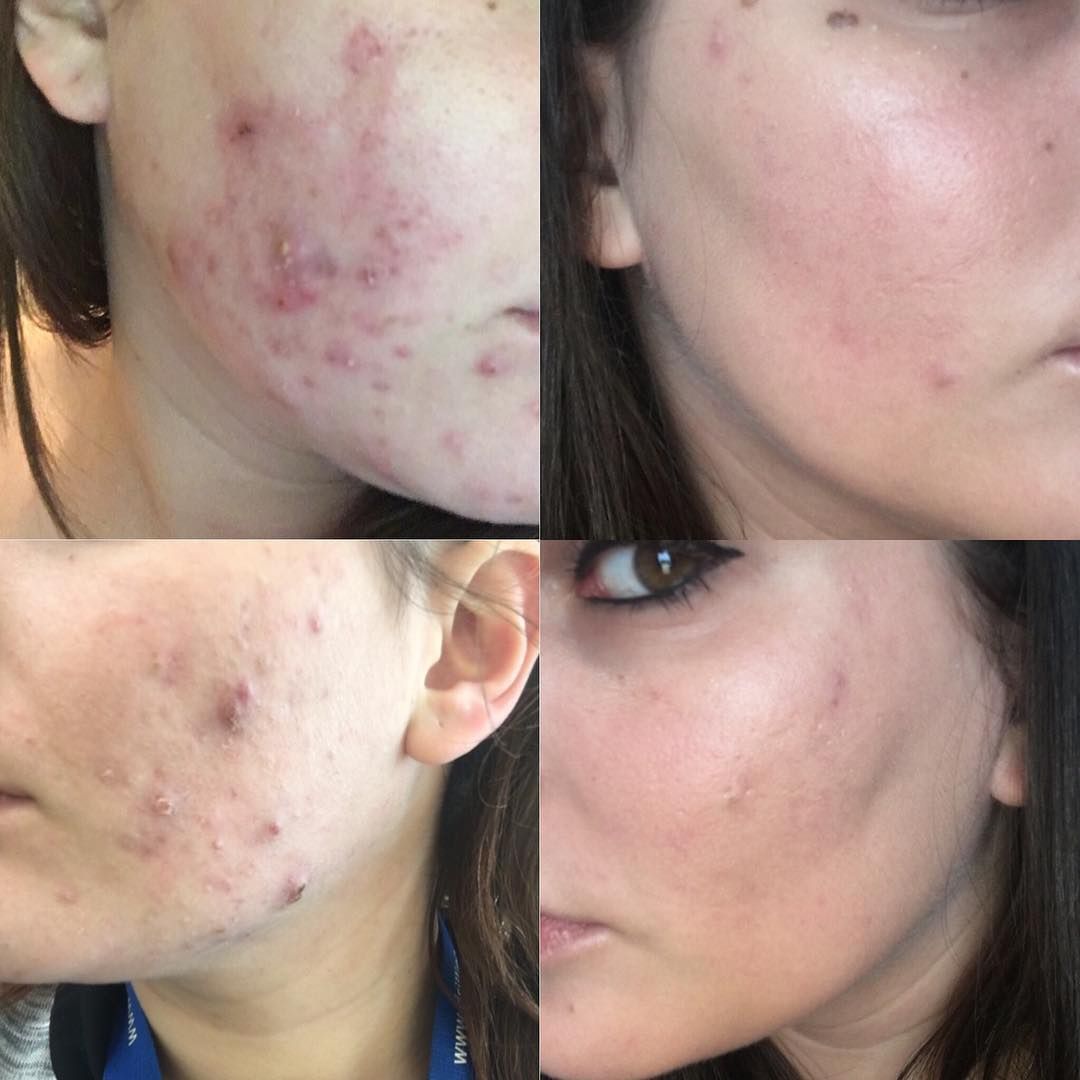 Accutane for teenage girl 3 months