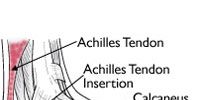 Achilles Tendinitis Medical Image