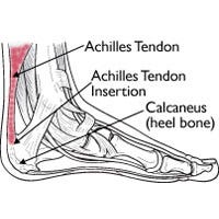 Does Increasing Plantar Flexion Really Help Achilles Tendinitis ...