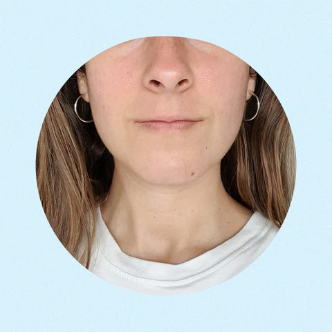 como quitar huecos del acne