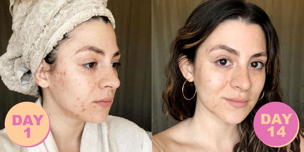 Does Alcohol Affect Skin And Breakouts I Got Sober Curious For Better Skin
