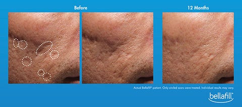 acne before and after acne before and after