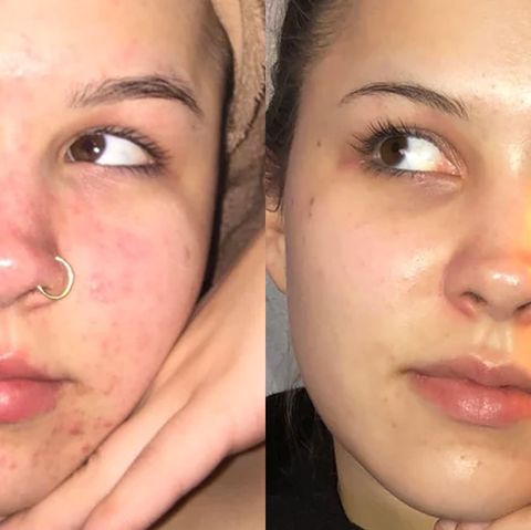 Acne Facial Porn - This Woman Treated Acne with 3 Products and the Before-and ...