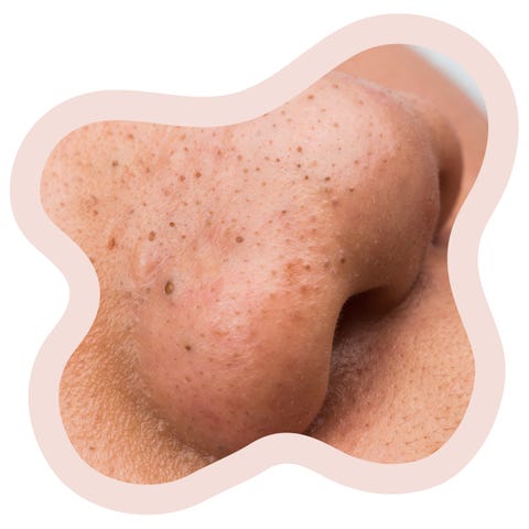 blackhead acne