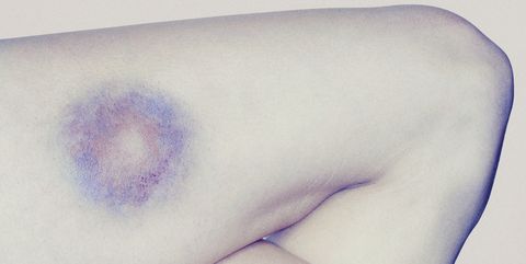 Bruise on leg