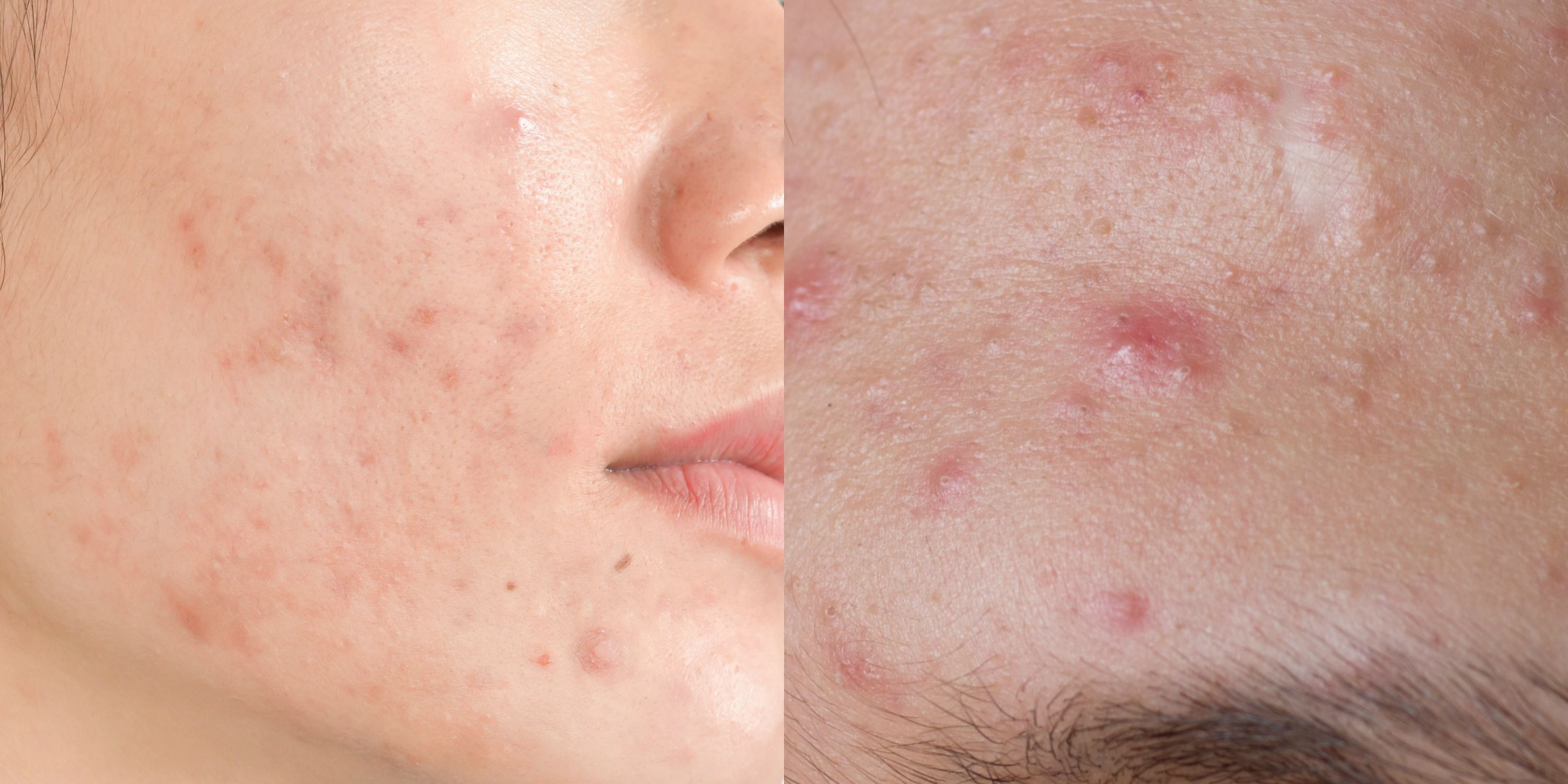 on face in of pimples adults Causes