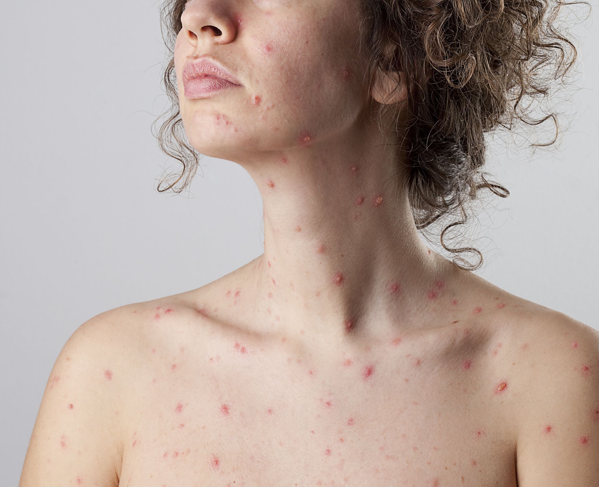 Everything You Need To Know About Chickenpox In Adults