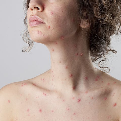 Can you get chicken pox twice in your life