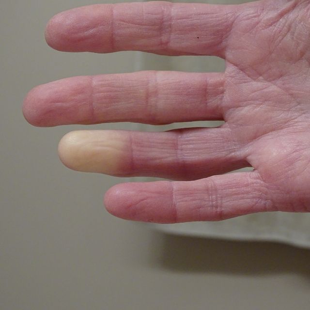 adult hand with raynaud’s syndrome