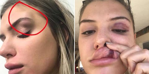 Alissa Violet Allegedly Punched In Face At Barley House Bar