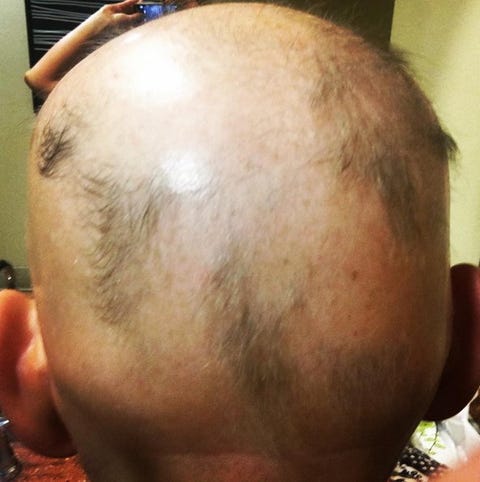 This Is What It's Like To Have Alopecia | Prevention