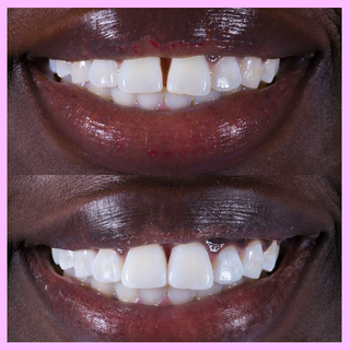 How I Closed the Gap in My Teeth With Biomimetic Dentistry How I Closed the Gap in My Teeth With Biomimetic Dentistry