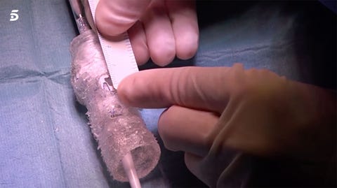 Imprimen una prótesis de aorta 3D y salvan la vida a un hombre