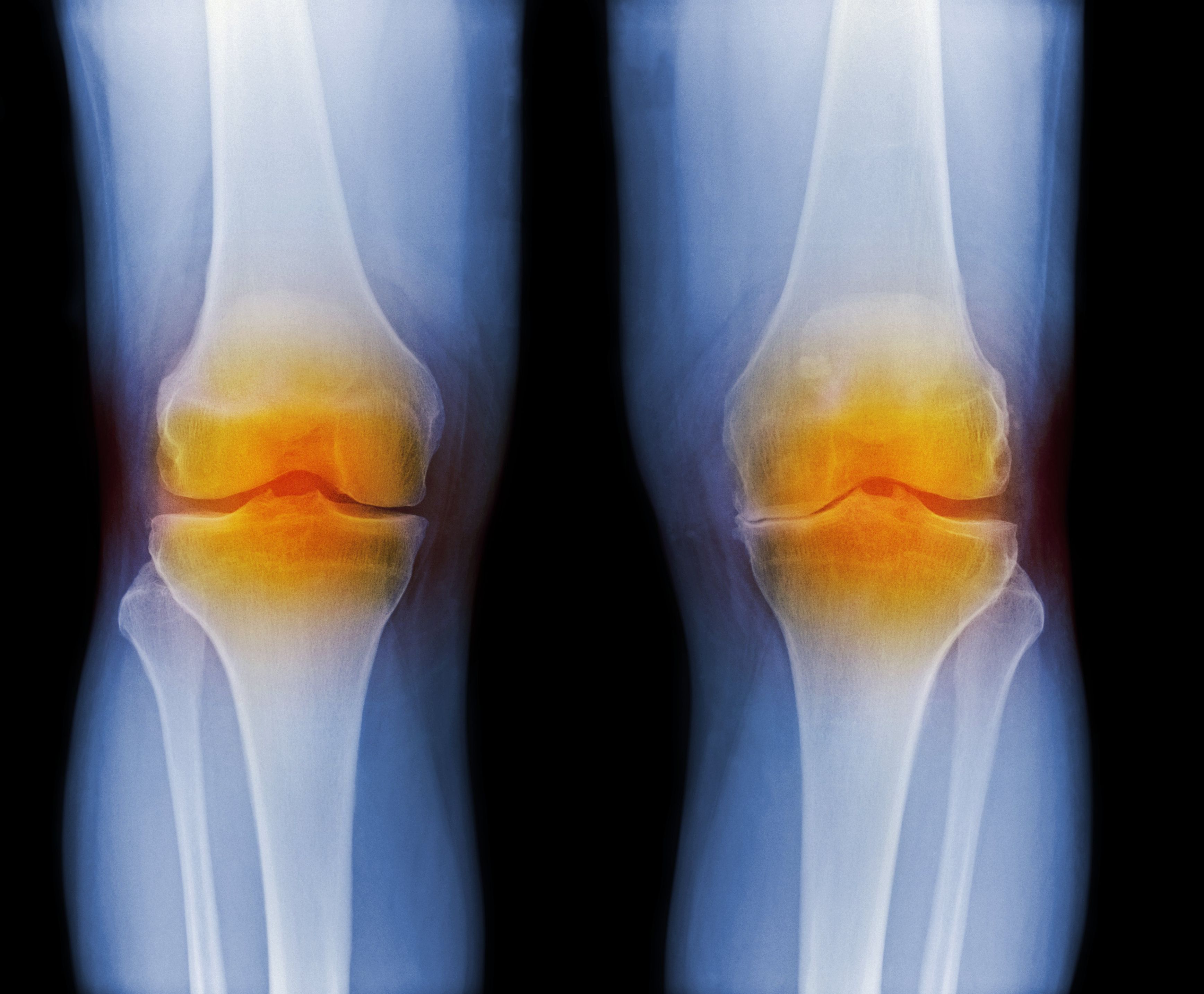 súlycsökkentő tippek az osteoarthritis ellen