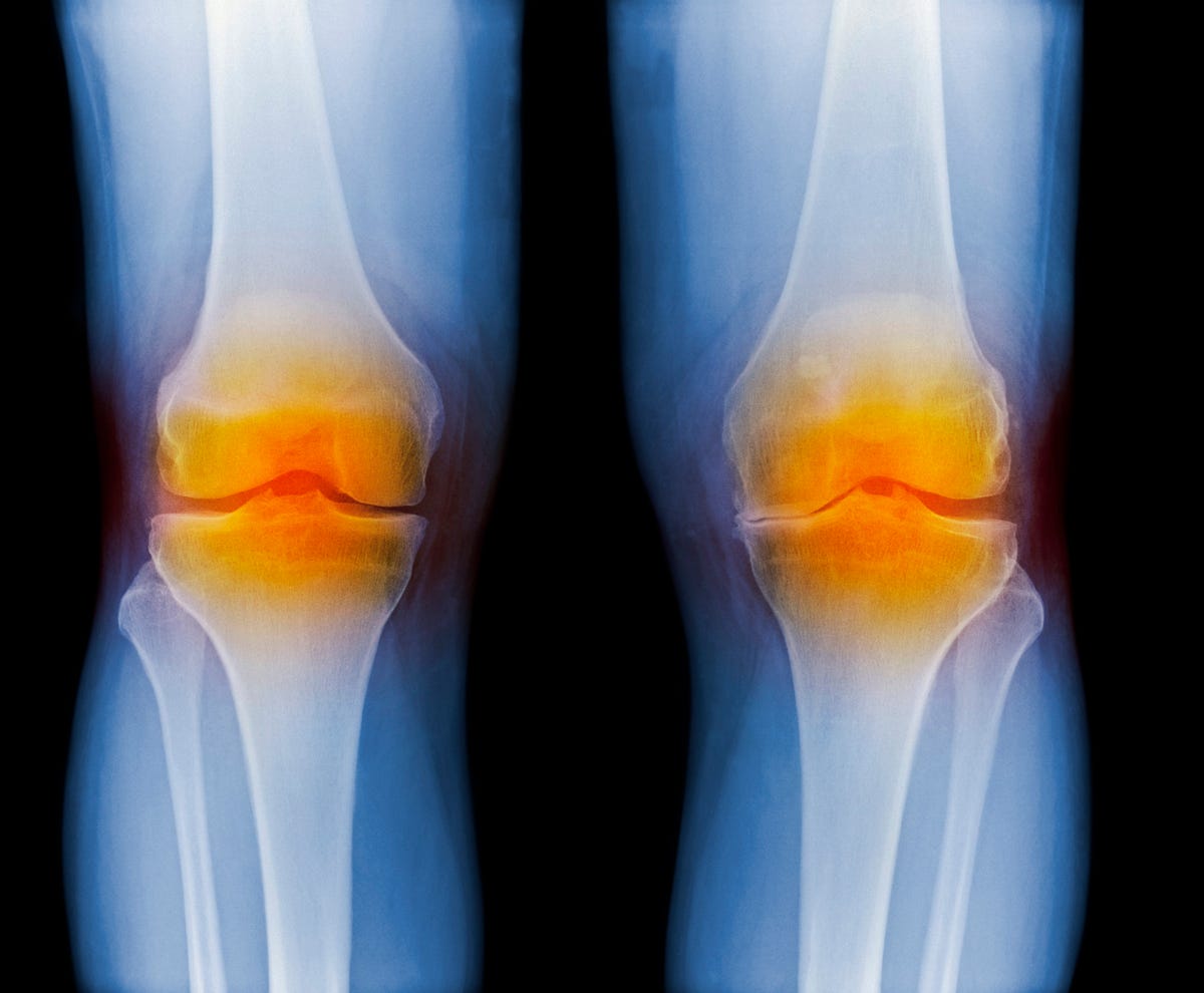 5-natural-osteoarthritis-treatments-what-is-osteoarthritis