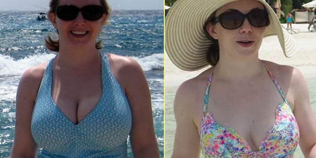 Flat Chest Hairy Nudist Beach - This Is What Breast-Reduction Surgery Is Really Like