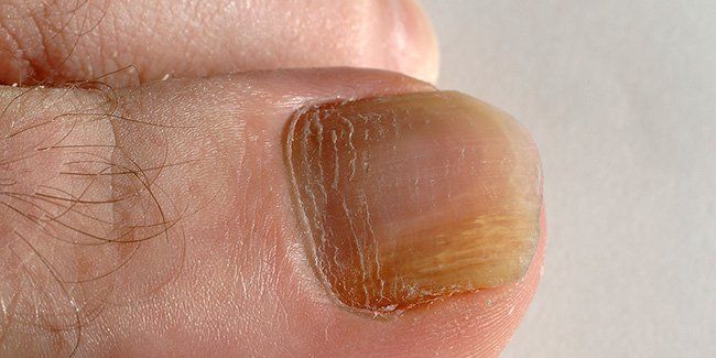 How To Prevent Nail Fungus And Treat It If It S Already Present Prevention