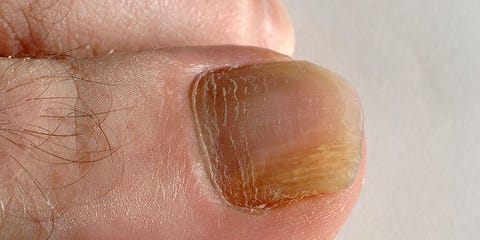 nail fungush foot eltávolítása)