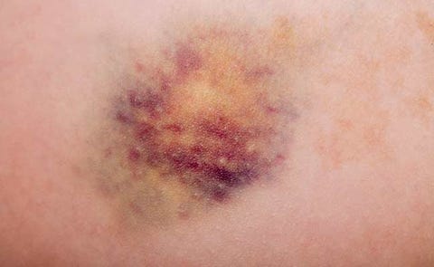 How To Heal Your Bruises A Whole Lot Faster