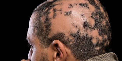 alopecia areata facts