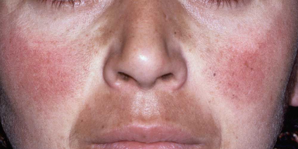 7 Melasma Treatments - How to Treat Brown Spots on Skin