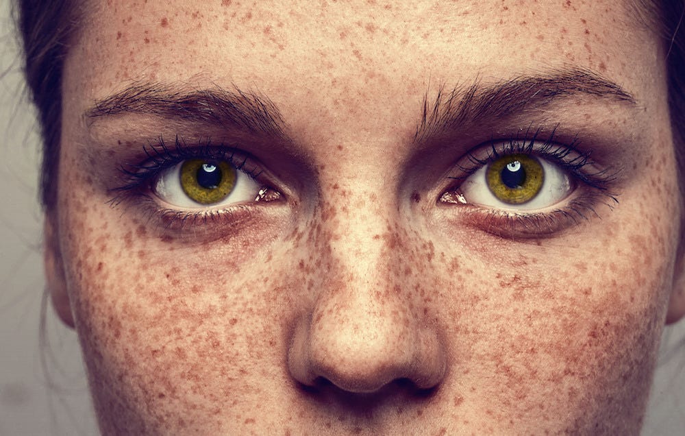 What All Women With Freckles Need To Know Prevention