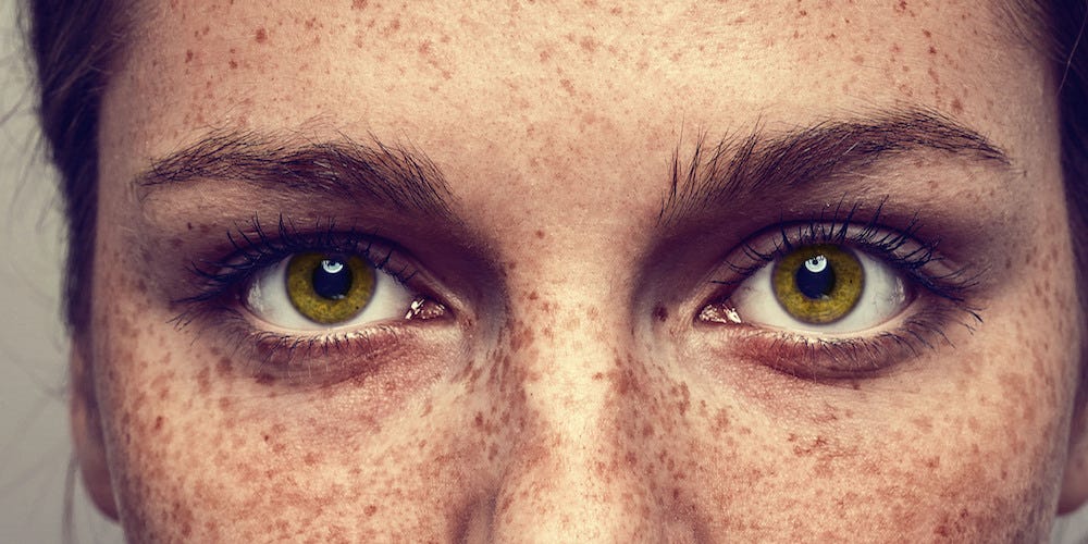 What All Women With Freckles Need To Know Prevention What All Women With Freckles Need To Know Prevention