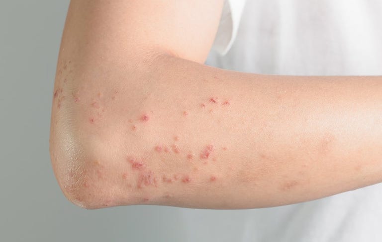 Hives On Back And Arms