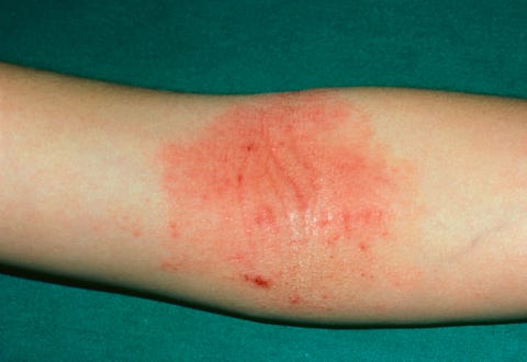 Eczema Causes, Symptoms, & Treatments - How to Get Rid of Eczema