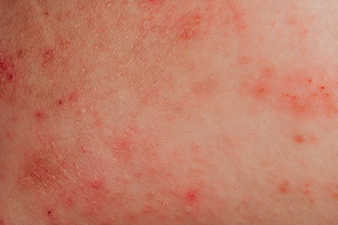 atopic eczema allergy texture