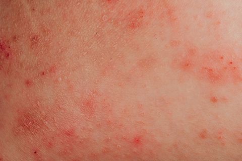 atopic eczema allergy texture of ill human skin