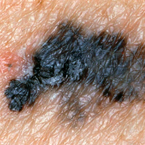 Is It Just A Mole—Or Something Worse? | Prevention