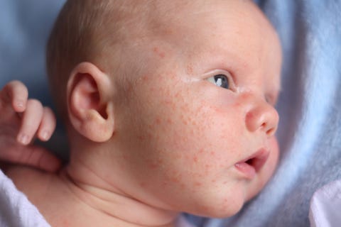 Baby acne: symptoms, signs and treatment