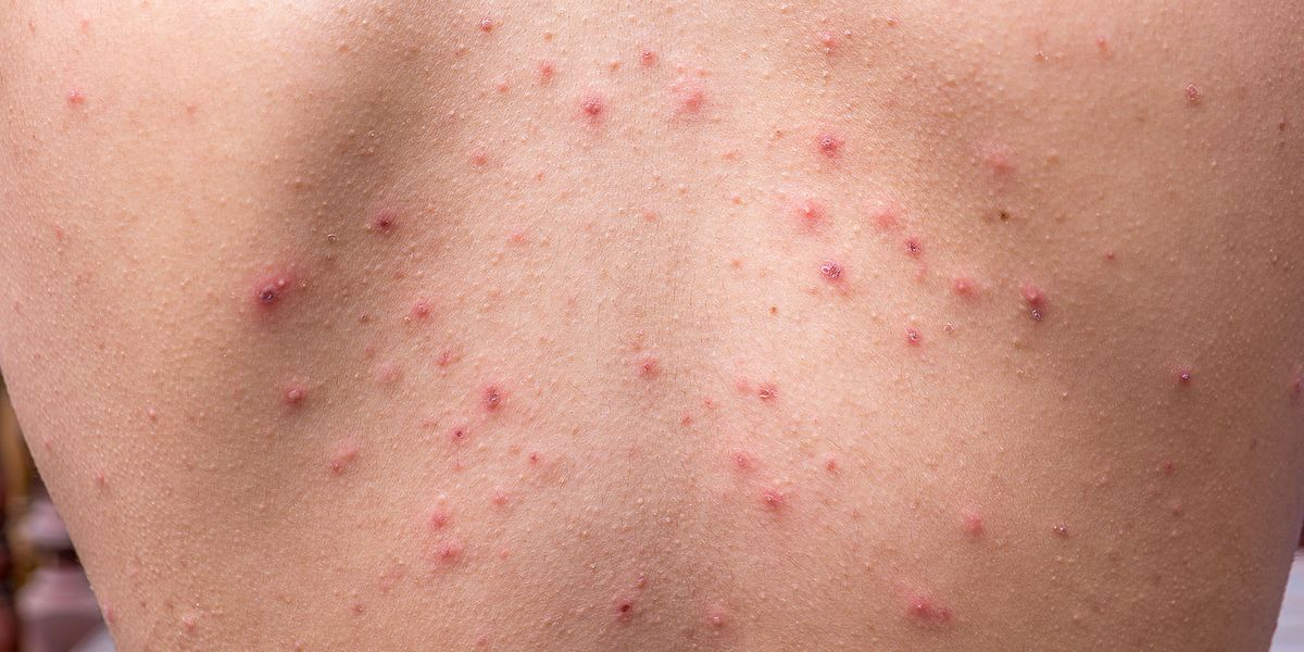 How to Get Rid of Bacne for Good - Best Back Acne Products and Treatments