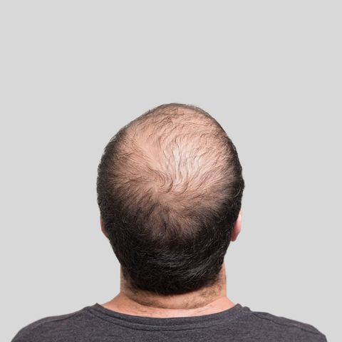 Male Pattern Baldness: How to Fight Hair Loss