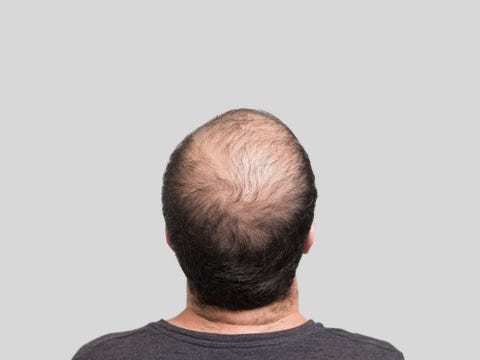 How To Fight Male Pattern Baldness