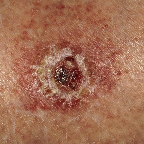 Skin Cancer Symptoms, Signs, Types, Treatments & Prevention