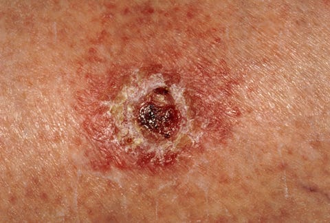 Skin Cancer Symptoms, Signs, Types, Treatments & Prevention