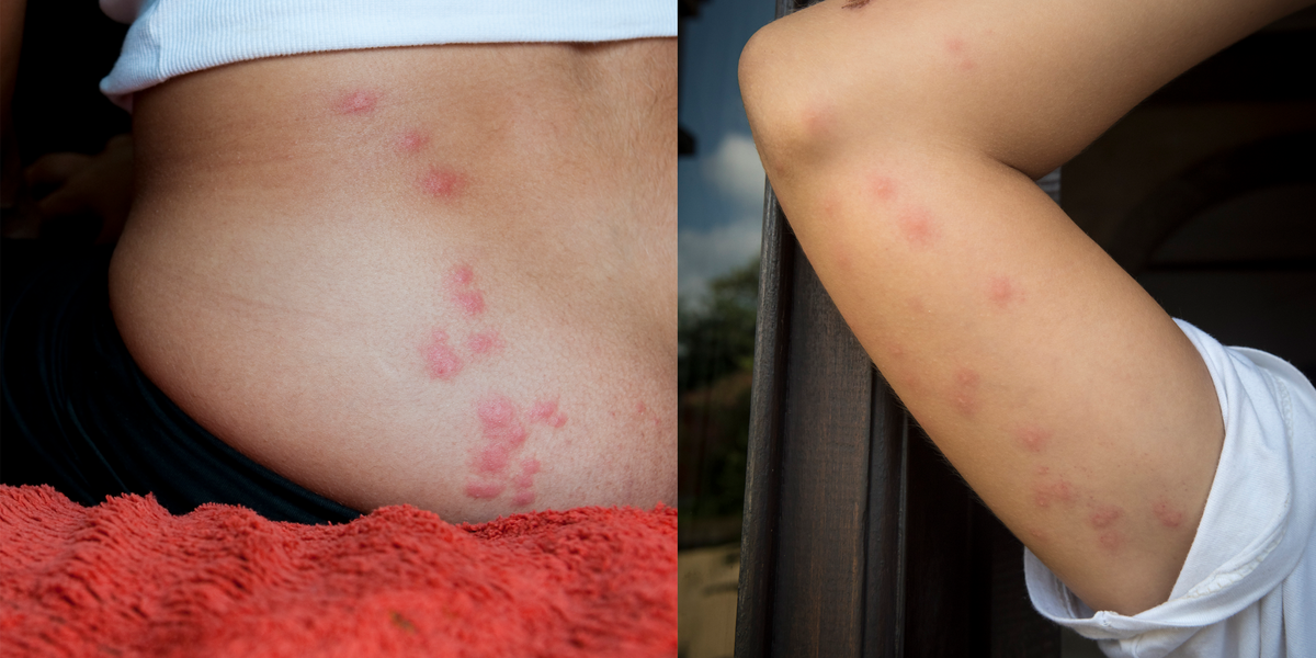 Bed Bug Bites Pictures Symptoms What, Can Bed Bugs Bite You Through The Sheets