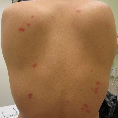 Cortisone Creams Are Powerful Skin Healers For Bites and Rashes Cortisone Creams Are Powerful Skin Healers For Bites and Rashes