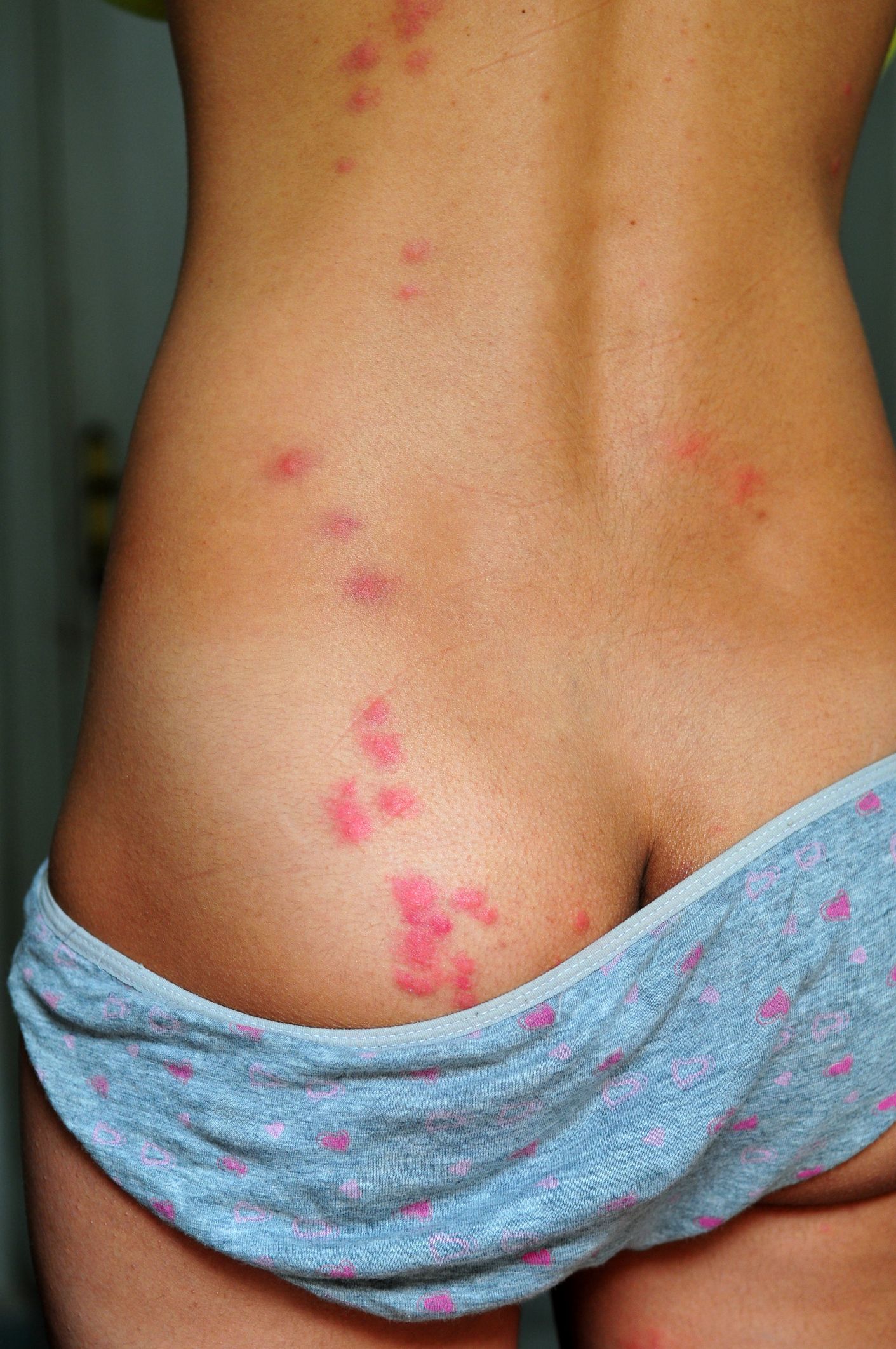 Bed Bug Bites Pictures Symptoms What Do Bed Bug Bites Look Like   Bedbug Bites On Womans Back And Buttocks Royalty Free Image 157635457 1566338783 