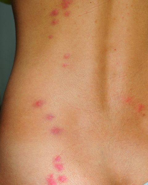 58 Top Pictures Do Bed Bugs Bite Cats - Bed Bug Bites on Humans - Bed Bug Bite Symptoms