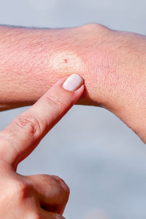 bee sting on human skin