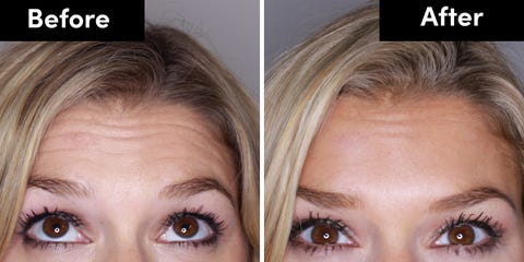 Botox Review - 9 Things You Need To Know Before Having It Botox Review - 9 Things You Need To Know Before Having It