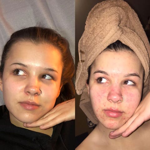 This Woman Treated Acne with 3 Products