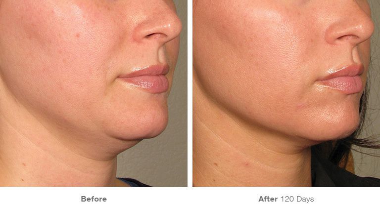 How Laser Skin Tightening Works Radiofrequency Skin Treatment