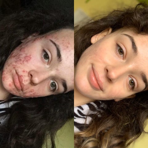 accutane before after